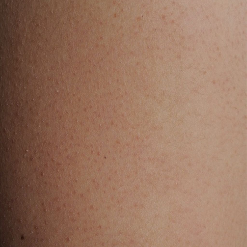 RASopathien ein Überblick Dermatologie Universimed Medizin im Fokus